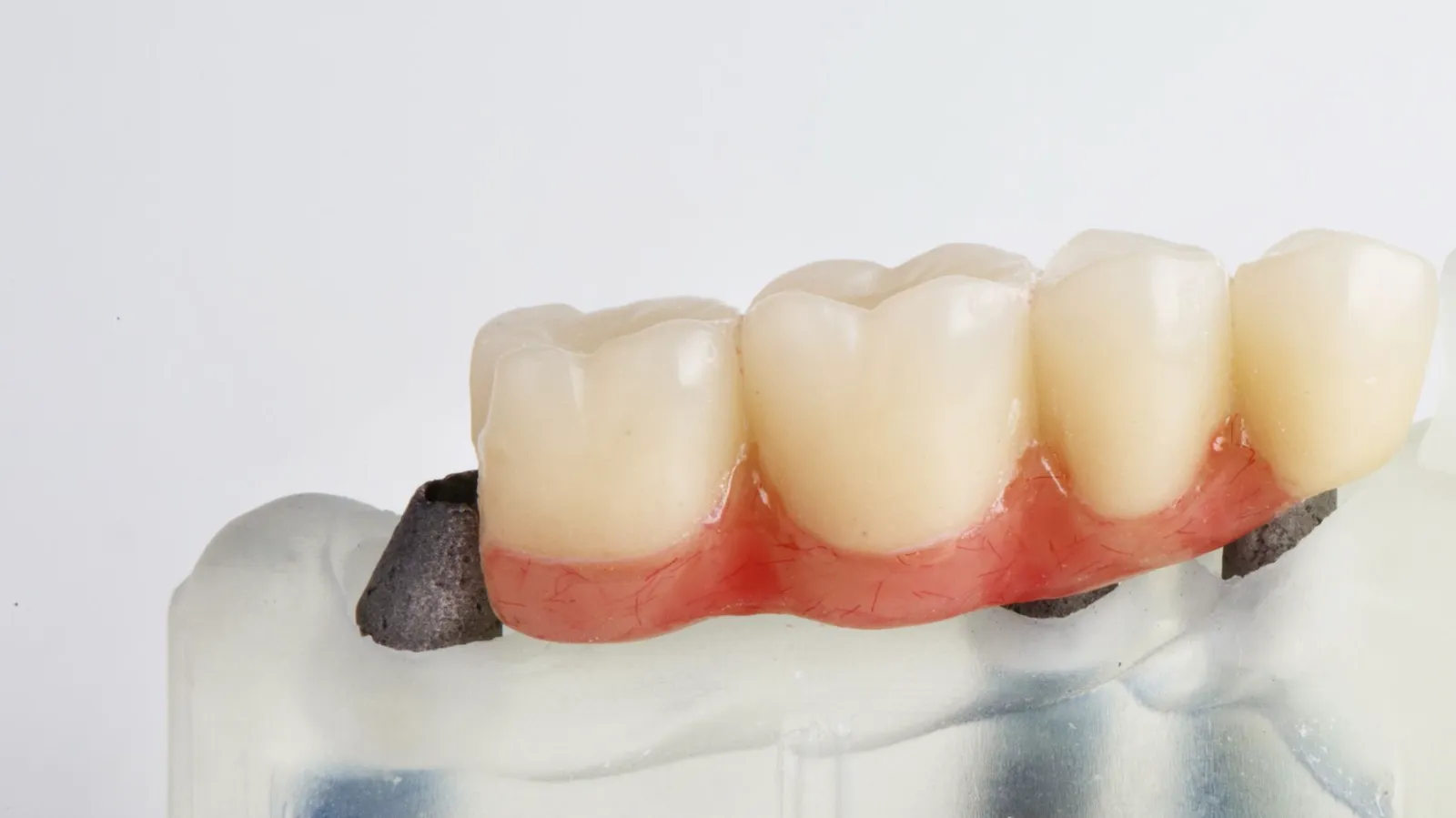 dental bridges