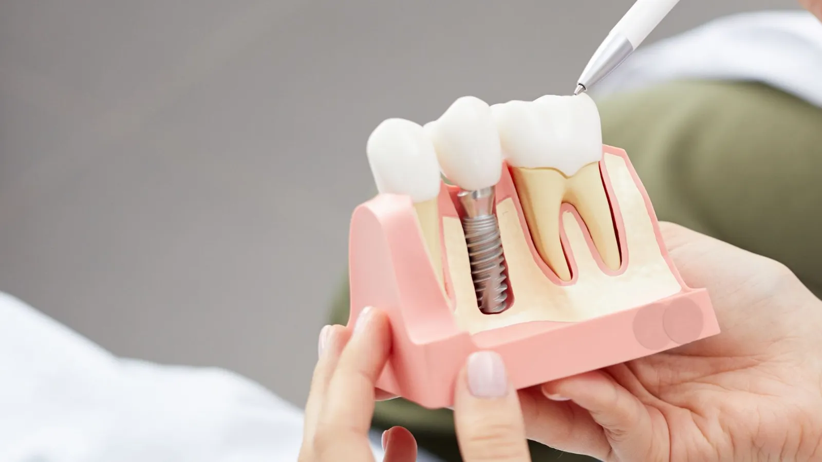 dental implants