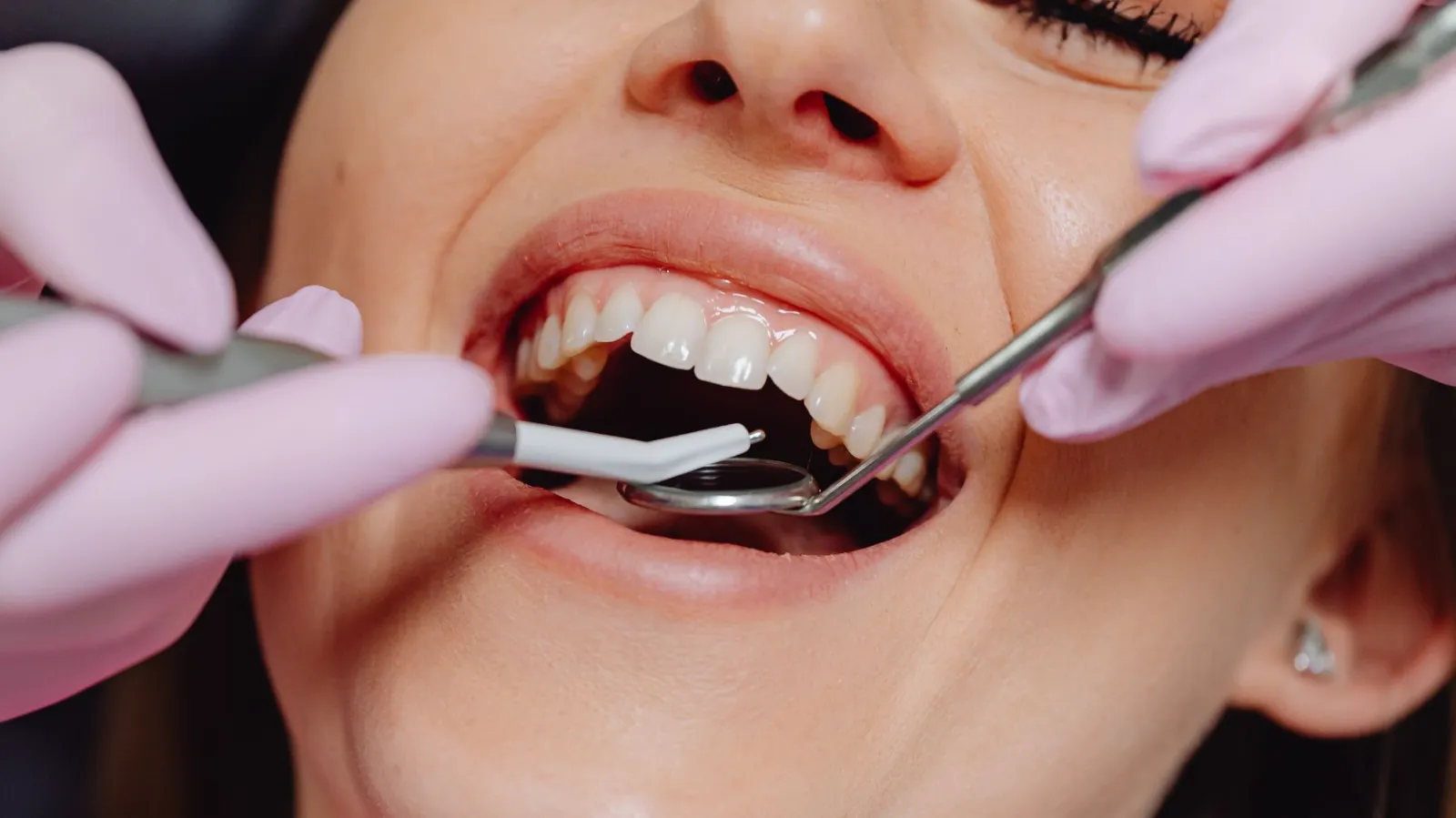 dental sealant
