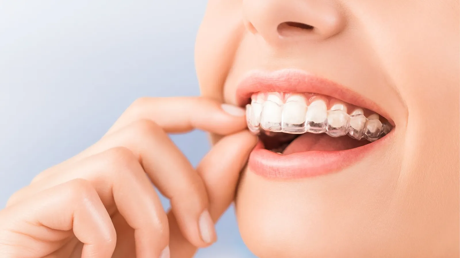 invisalign