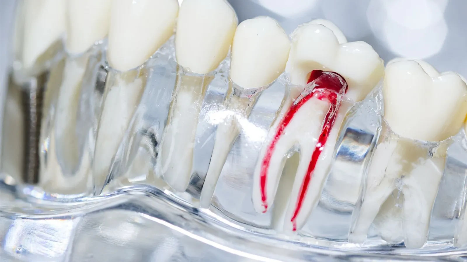 non surgical root canal