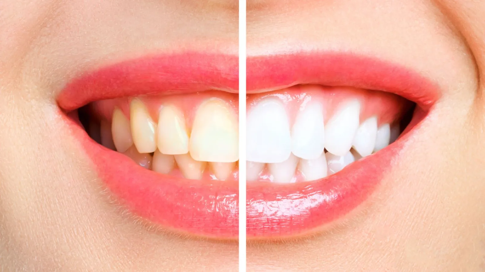 teeth whitening