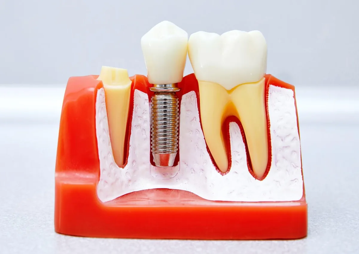Dental implant model showing a single-tooth replacement option for affordable dental implants.