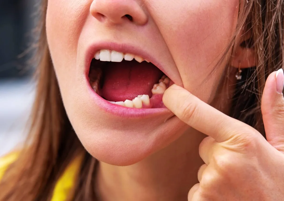 Patient showing a healing extraction area while checking the appearance of a normal tooth socket.