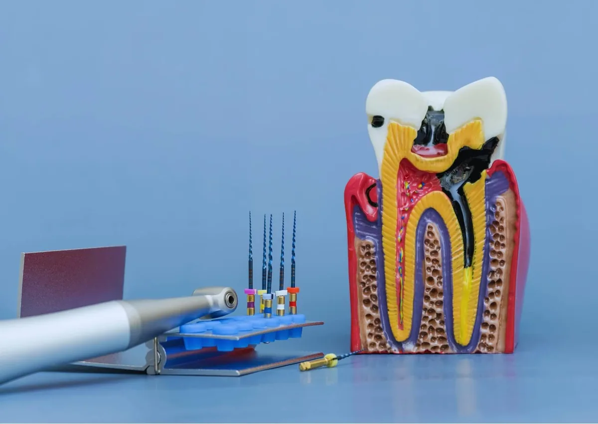 Tooth model and endodontic instruments illustrating root canal treatment and factors that affect root canal cost.